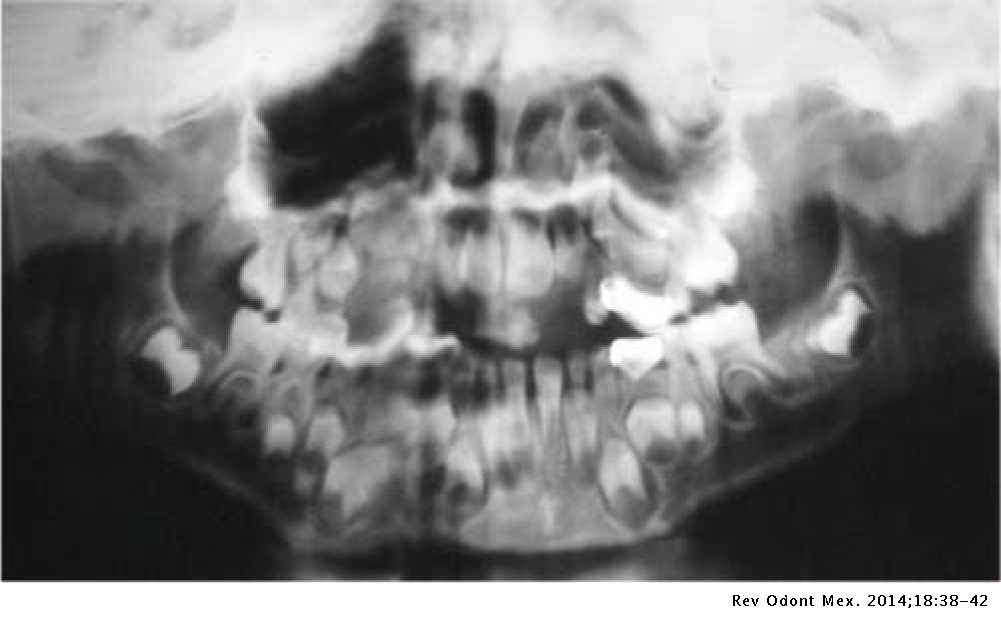 AMAUROSIS CONGENITA DE LEBER